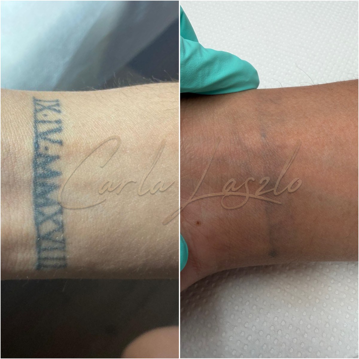 Ștergere tatuaj corporal cu laser